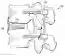 Fig. 01 - Materials, devices, and methods for treating multiple spinal regions including the anterior region