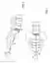 Fig. 03 - Method of percutaneous paracoccygeal pre-sacral stabilization of a failed artificial disc replacement