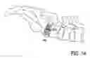 Fig. 07 - Method of percutaneous paracoccygeal pre-sacral stabilization of a failed artificial disc replacement