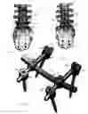 Fig. 02 - Spondylolistheses correction system and method of correcting spondylolistheses