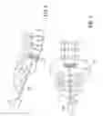 Fig. 03 - Method of percutaneous paracoccygeal pre-sacral stabilization of a failed artificial disc replacement