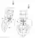 Fig. 04 - Method of percutaneous paracoccygeal pre-sacral stabilization of a failed artificial disc replacement