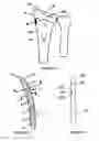 Fig. 02 - Intramedullary implant for fracture fixation and method of using the same