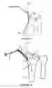 Fig. 04 - Intramedullary implant for fracture fixation and method of using the same