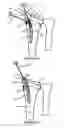 Fig. 05 - Intramedullary implant for fracture fixation and method of using the same