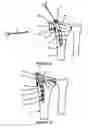 Fig. 06 - Intramedullary implant for fracture fixation and method of using the same