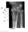Fig. 07 - Intramedullary implant for fracture fixation and method of using the same