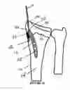 Fig. 08 - Intramedullary implant for fracture fixation and method of using the same