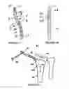Fig. 09 - Intramedullary implant for fracture fixation and method of using the same