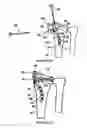 Fig. 11 - Intramedullary implant for fracture fixation and method of using the same