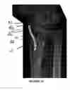 Fig. 12 - Intramedullary implant for fracture fixation and method of using the same