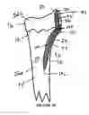 Fig. 13 - Intramedullary implant for fracture fixation and method of using the same