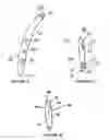 Fig. 14 - Intramedullary implant for fracture fixation and method of using the same