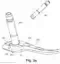 Fig. 04 - Targeting device for bone implant