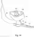 Fig. 07 - Targeting device for bone implant