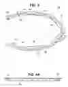 Fig. 07 - Craniotomy closures and plugs