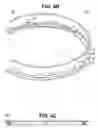 Fig. 08 - Craniotomy closures and plugs
