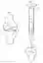 Fig. 02 - Osteochondral implant procedure and device