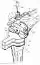 Fig. 01 - Bone jig