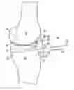 Fig. 01 - Bone resection apparatus and method for knee surgery