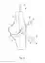 Fig. 03 - Bone resection apparatus and method for knee surgery
