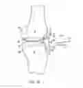 Fig. 06 - Bone resection apparatus and method for knee surgery
