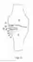 Fig. 07 - Bone resection apparatus and method for knee surgery