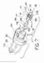 Fig. 06 - Split thread orthopaedic implant impactor