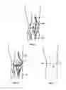 Fig. 03 - Apparatus and Method for Sculpting the Surface of a Joint