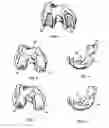 Fig. 04 - Apparatus and Method for Sculpting the Surface of a Joint