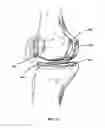 Fig. 10 - Apparatus and Method for Sculpting the Surface of a Joint
