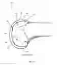 Fig. 15 - Apparatus and Method for Sculpting the Surface of a Joint
