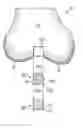 Fig. 01 - Osteochondral implant fixation procedure and bone dilator used in same