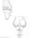 Fig. 02 - Osteochondral implant fixation procedure and bone dilator used in same
