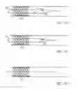 Fig. 05 - Embolic protection system
