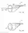 Fig. 47 - Embolic protection system