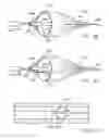 Fig. 48 - Embolic protection system