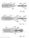 Fig. 51 - Embolic protection system