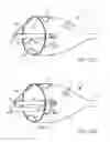 Fig. 60 - Embolic protection system