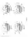 Fig. 08 - Retrievable blood clot filter
