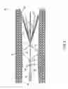 Fig. 09 - Retrievable blood clot filter