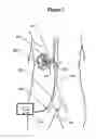 Fig. 04 - Renal nerve stimulation method for treatment of patients