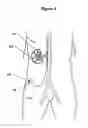 Fig. 05 - Renal nerve stimulation method for treatment of patients