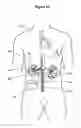 Fig. 11 - Renal nerve stimulation method for treatment of patients