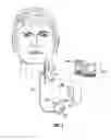 Fig. 02 - Spark gap in an implantable medical device