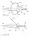 Fig. 10 - APPARATUS AND METHODS FOR LOCATING AN OSTIUM OF A VESSEL