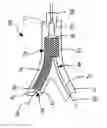 Fig. 01 - Bifurcation stent delivery system