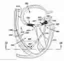 Fig. 01 - Translumenal apparatus, system, and method