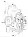 Fig. 02 - Translumenal apparatus, system, and method