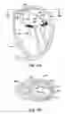 Fig. 14 - Translumenal apparatus, system, and method